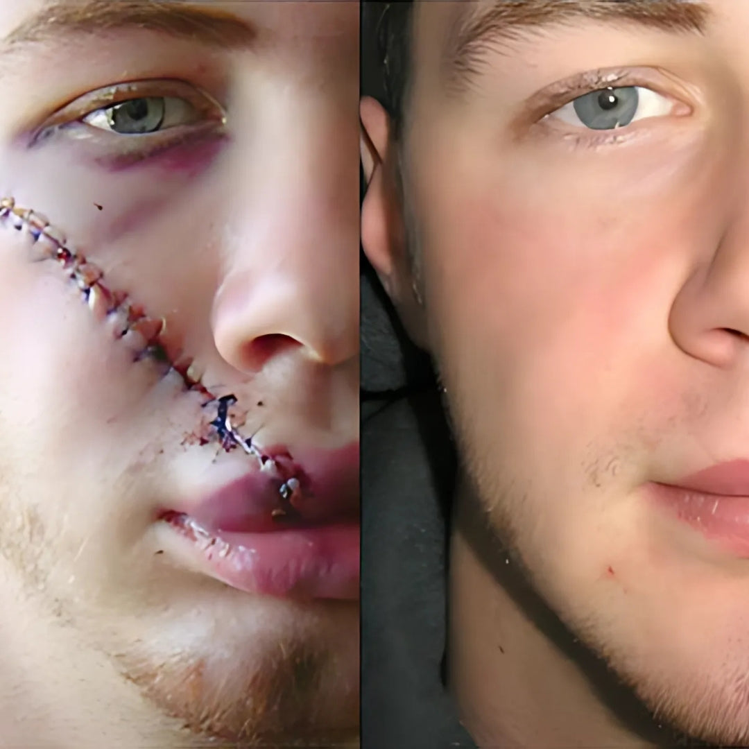 Scar Spray | Lässt Narben schnell und effektiv verblassen