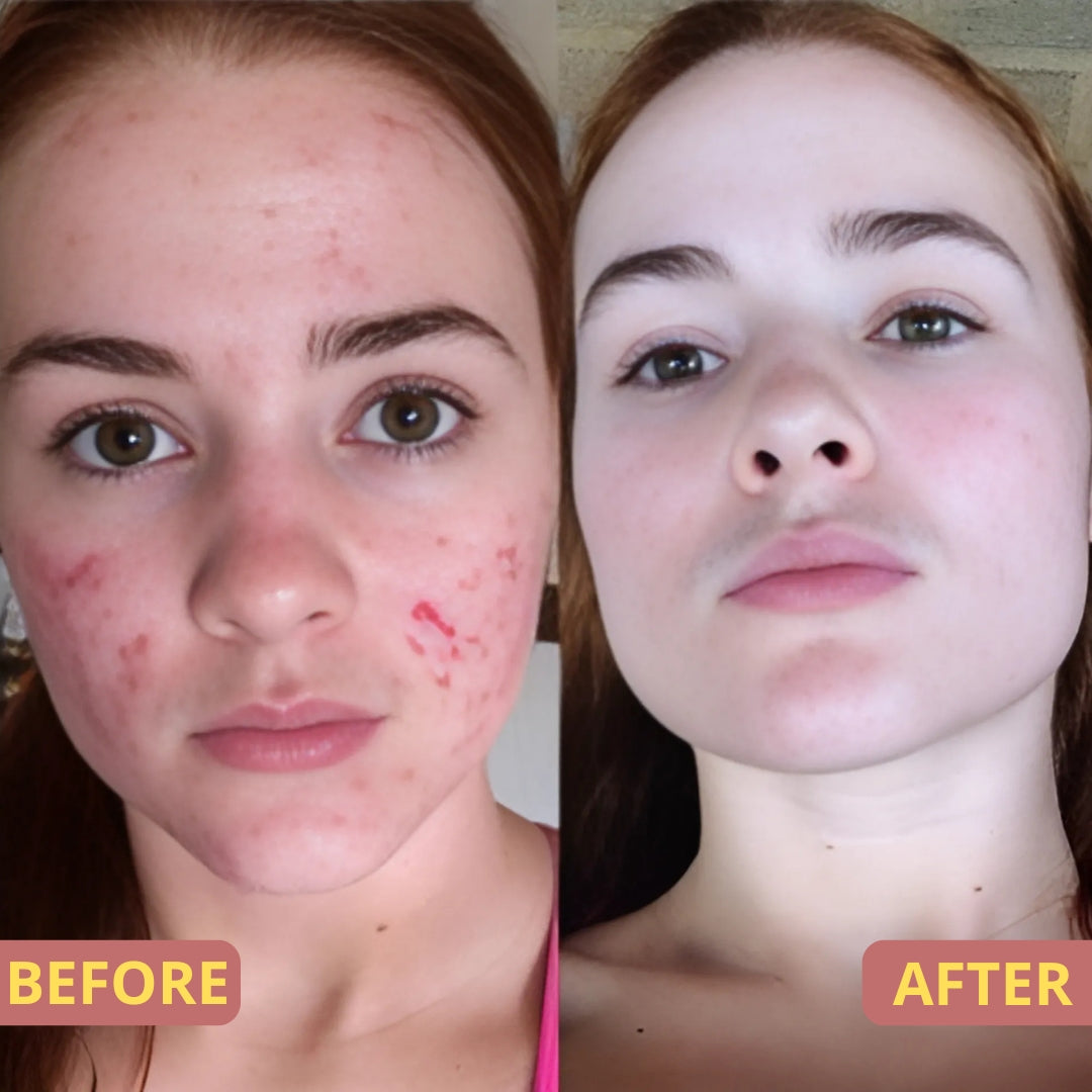 Scar Spray | Lässt Narben schnell und effektiv verblassen