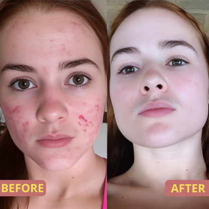 Scar Spray | Lässt Narben schnell und effektiv verblassen